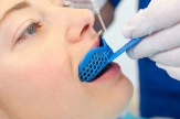 従来の歯の型取り方法